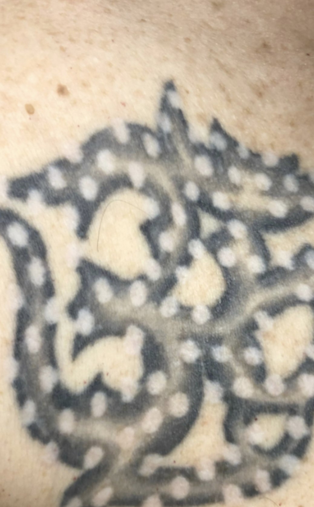 removal of chest tattoo