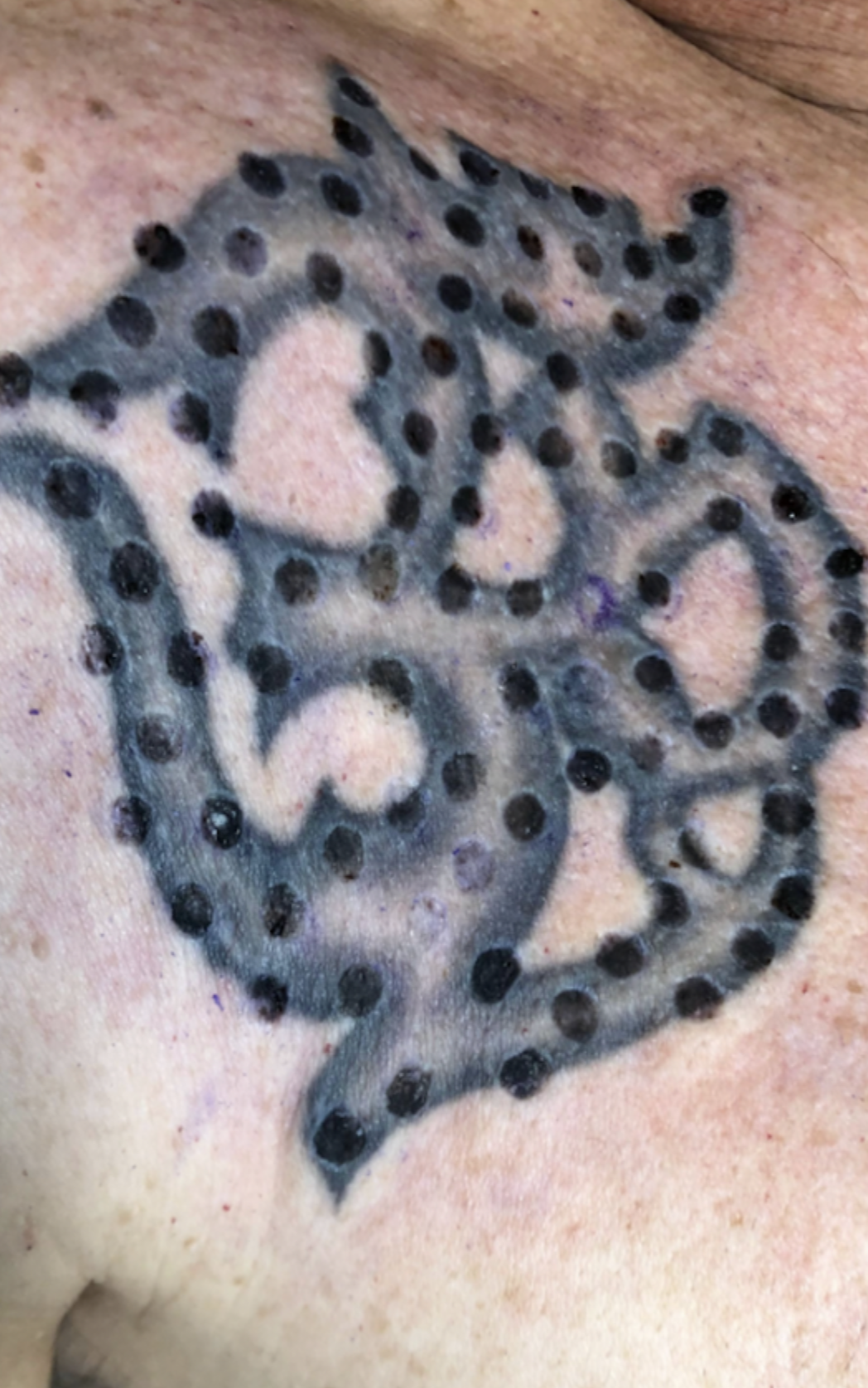 chest tattoo removal during the process