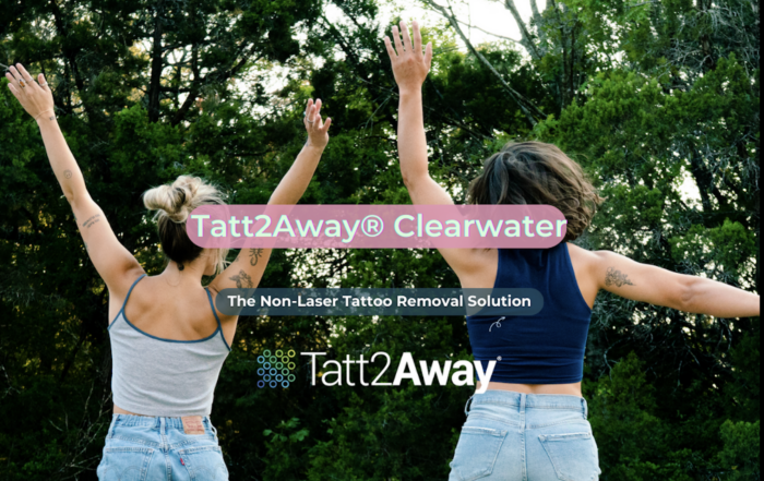 tattoo removal clearwater florida