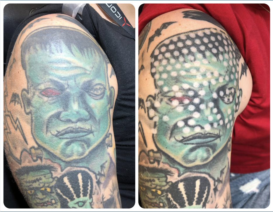 before and after non laser tattoo removal during the process