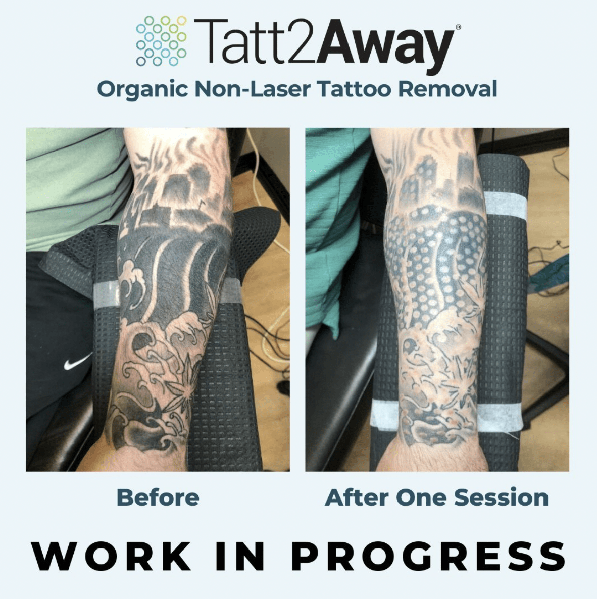 tatt2away before and after tattoo removal