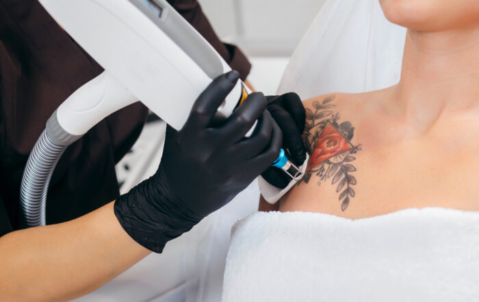 person getting laser tattoo removal on her shoulder