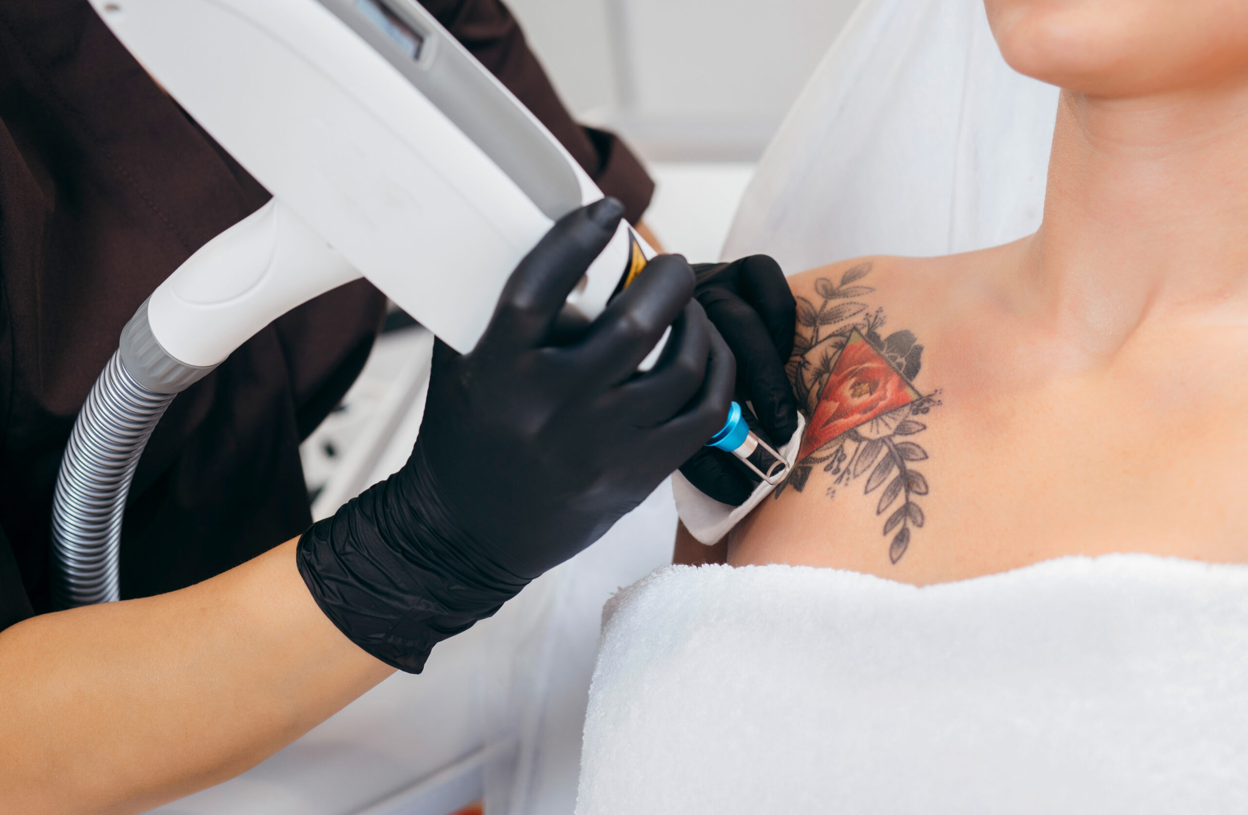 person getting laser tattoo removal on her shoulder