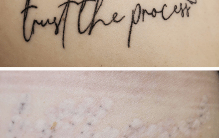 non laser tattoo removal during the process