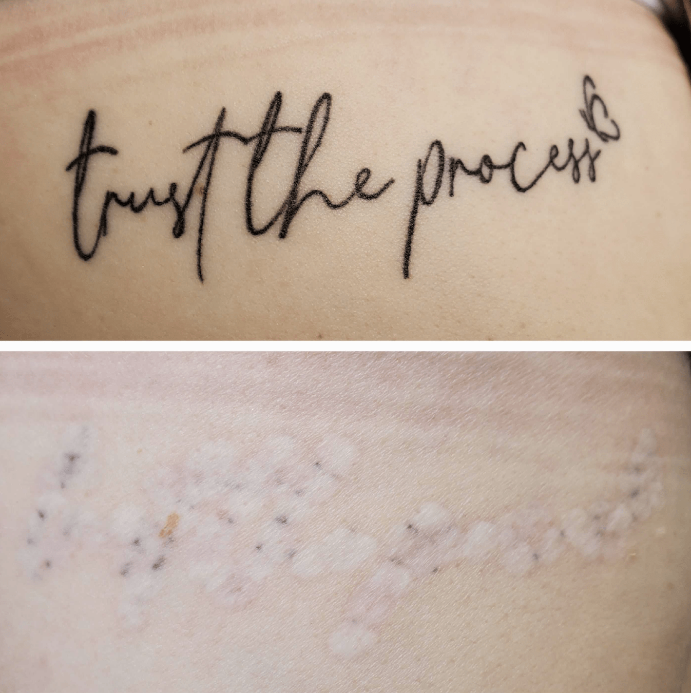 non laser tattoo removal during the process