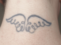 angel tattoo before removal