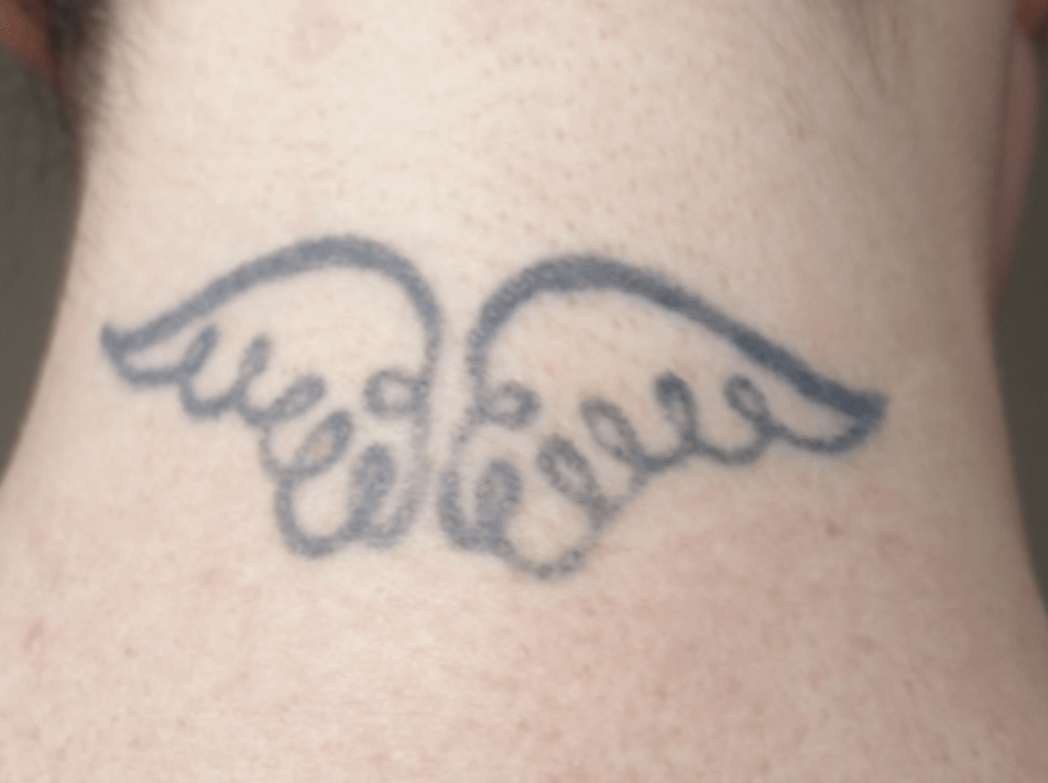 angel tattoo wings before removal