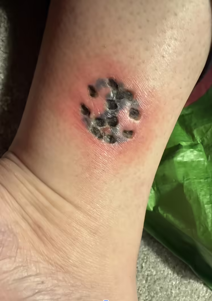 bad results from tattoo removal